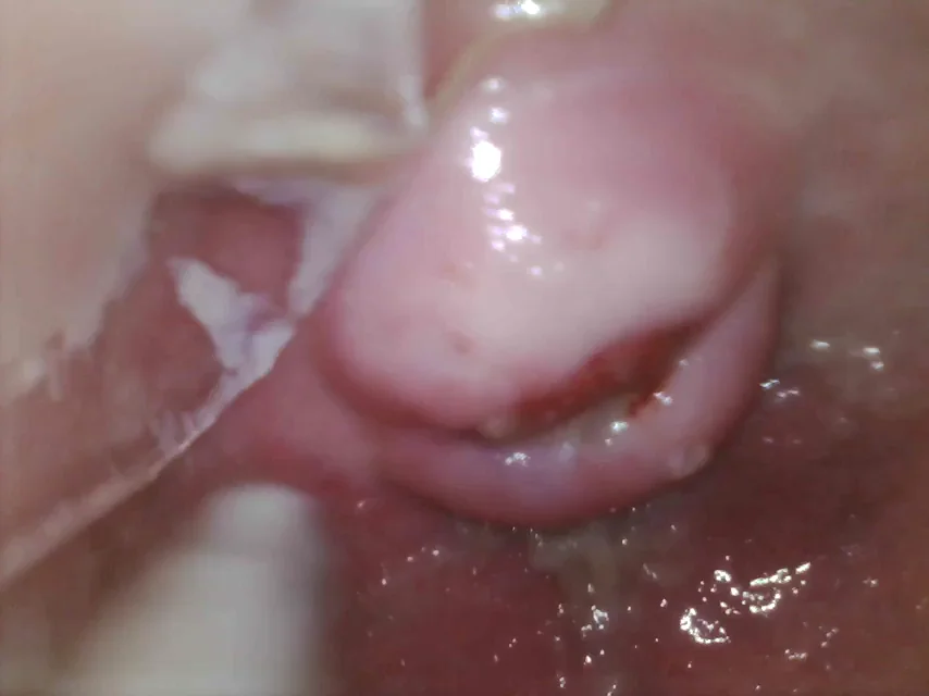 [Internal view] Wow with as gaping as my cervix looked I assumed it would slide right in, apparently I cant even do that right!