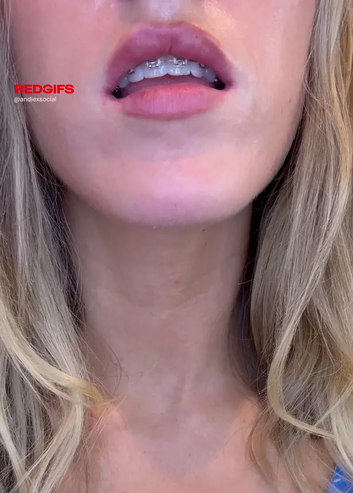 Why My Braceface Lips Stay So Dry & Fuckable 😘💋🔩